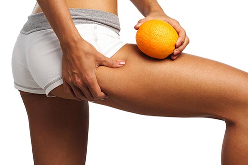 cellulitis